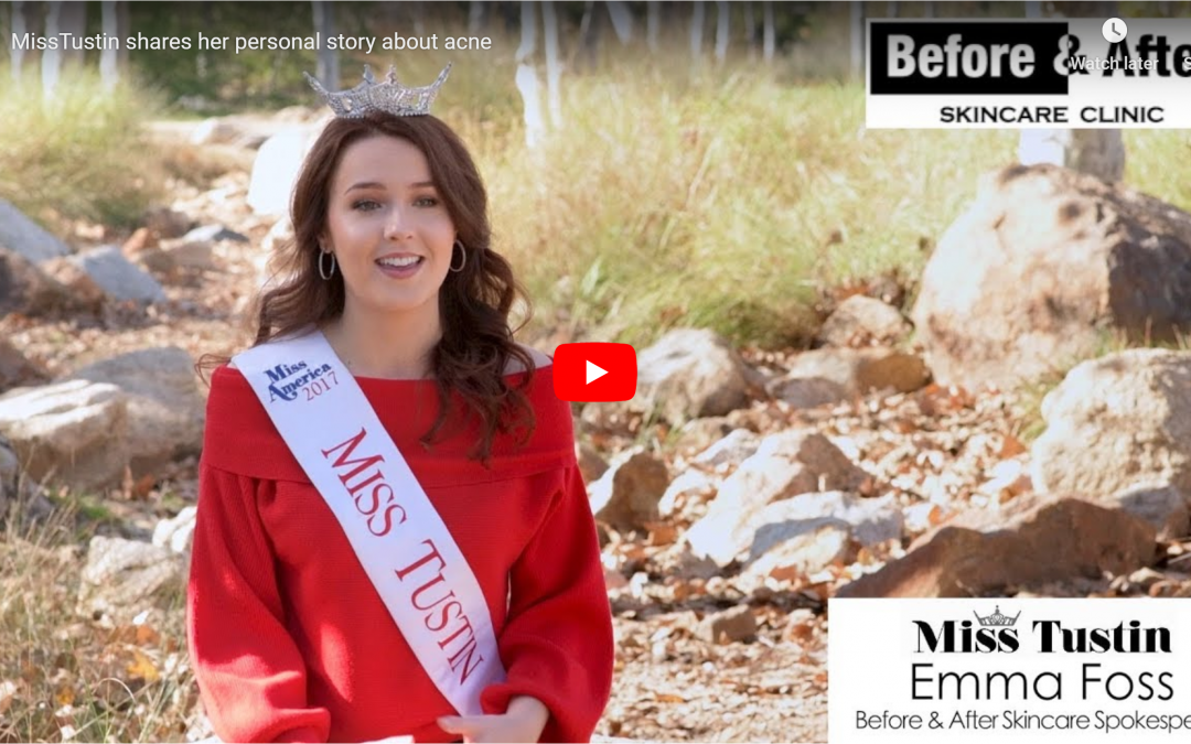 2017 Miss Tustin shares her personal story about Before and After Skincare clinic